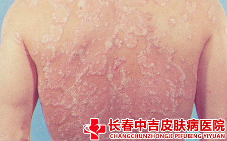 导致银屑病的原因
