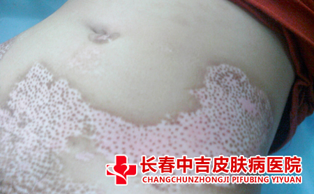 白癜风应该怎么进行治疗