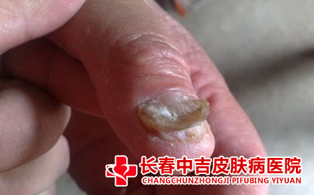 导致灰指甲的原因有什么