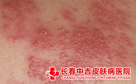 导致湿疹的原因有什么