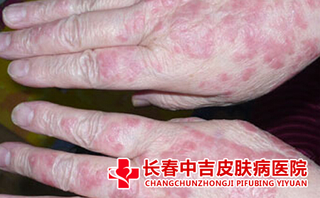 怎么预防皮炎的复发