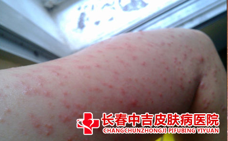 皮炎患者应该怎么注意护理