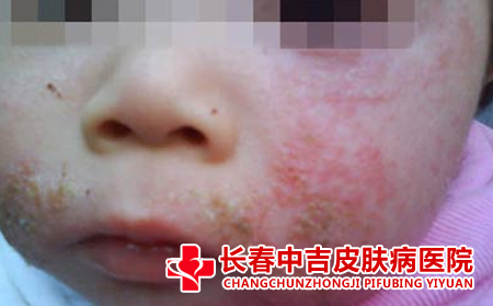 湿疹患者应该怎么注意日常护理