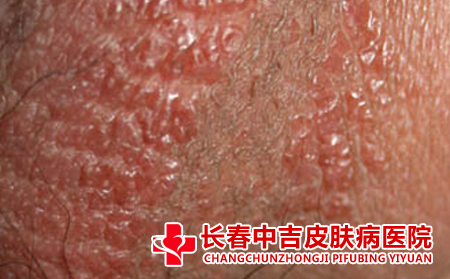 湿疹与牛皮癣之间的关联
