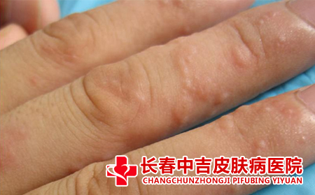 脂溢性皮炎如何引起的