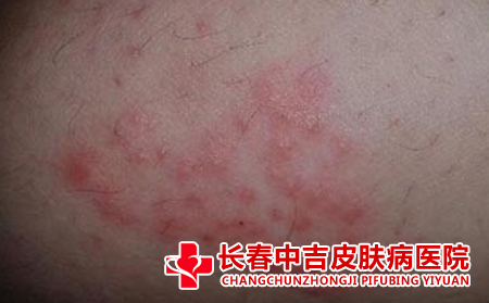 过敏了怎么办