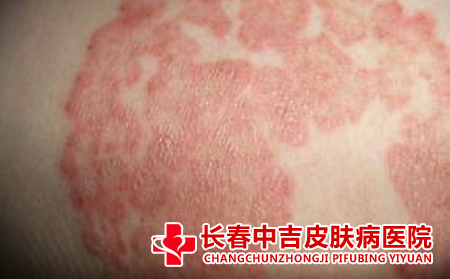  日光性皮炎受到光照的影响