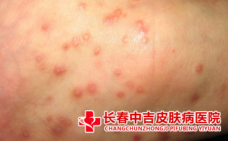 什么是药疹的症状