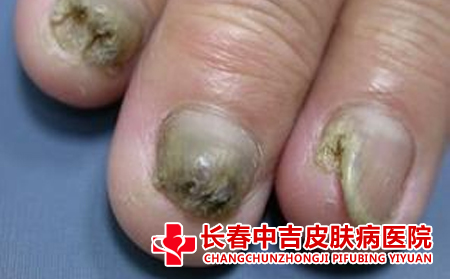 不忍心让婆婆的灰指甲接触到孩子,会传染给宝