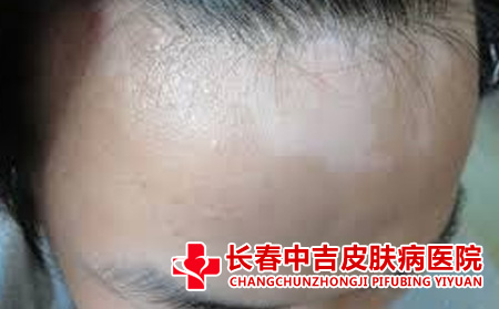 白癜风怎么治疗