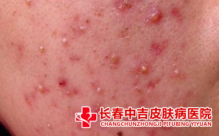 痤疮治疗