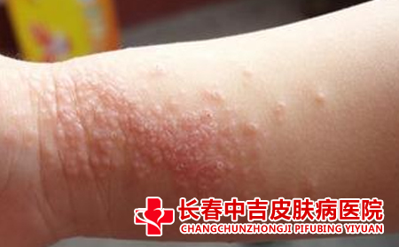 长春怎样治疗皮炎