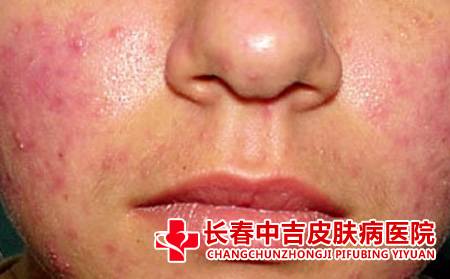 长春哪里治疗痤疮合适