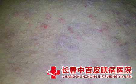 为什么冬季多发生这种皮肤瘙痒症状