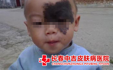 为什么会发生太田痣