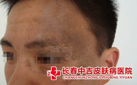 太田痣还能恢复吗