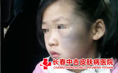 太田痣哪个医院比较专业