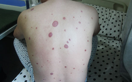 背部脓疱型银屑病症状