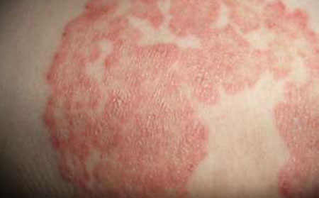 湿疹复发时有什么症状