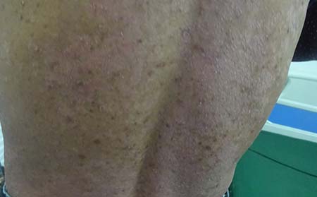 牛皮癣怎么护理