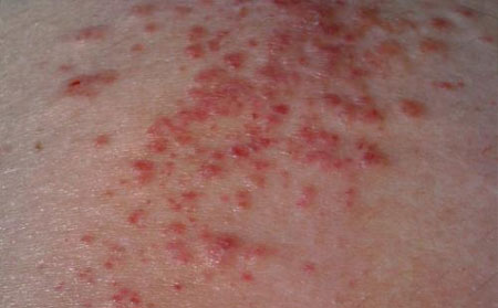 湿疹的危害有什么