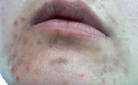 痘痘患者的护理方法