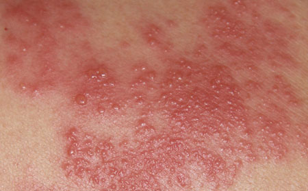 湿疹的诱因有什么
