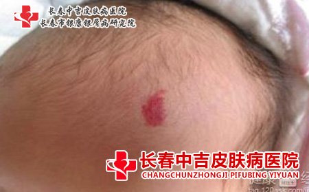 鲜红斑痣是怎么引起的-长春祛胎记好的医院排名