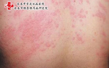 皮炎