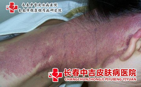 鲜红斑痣