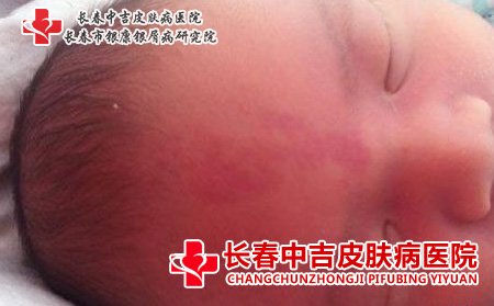 鲜红斑痣