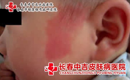 鲜红斑痣