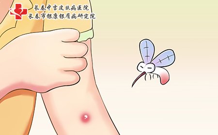 荨麻疹