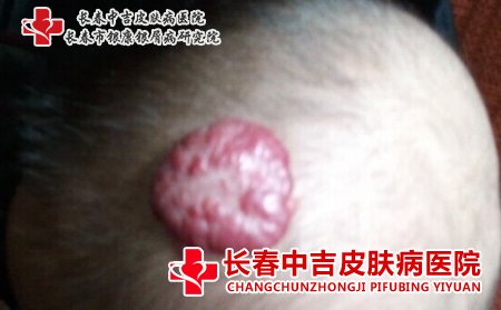 血管瘤