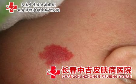 手术去除鲜红斑痣是不错的选择