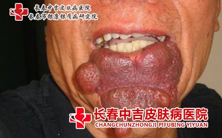 血管瘤良性，对身体的危害并不厉害，但依然要去医院检查，以防变成恶性