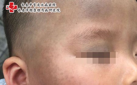 太田痣遗传吗,太田痣遗传孩子吗