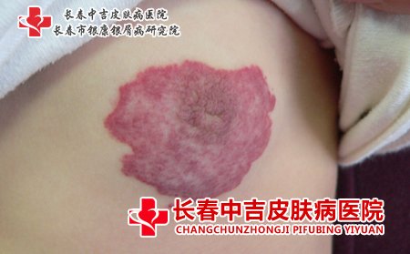血管瘤大多是良性