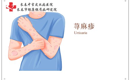 荨麻疹因素大多是因为过敏引起