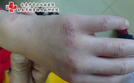 初期银屑病症状,手部银屑病症状