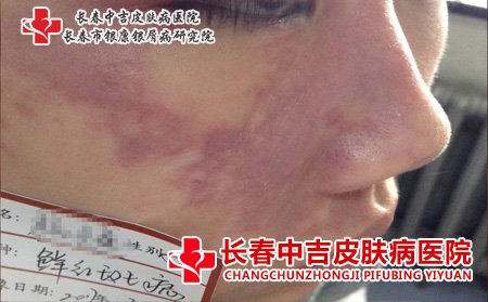鲜红斑痣