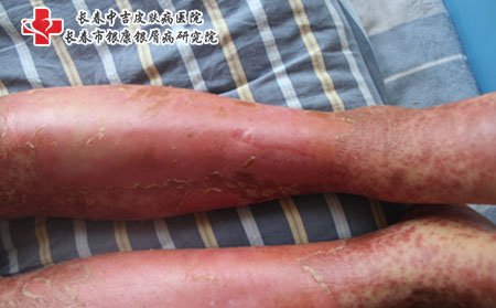 红皮型银屑病,红皮型银屑病治疗