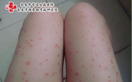 银屑病预防,儿童银屑病的预防